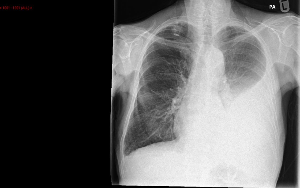 An x-ray of a patient suffering from malignant pleural effusion.